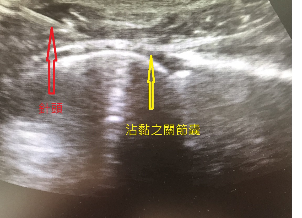 超音波導引 肩關節囊擴張術前